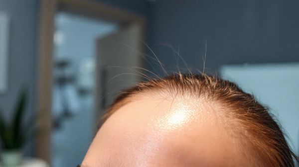 Greffe de cheveux : tout ce que vous n'osez pas demander